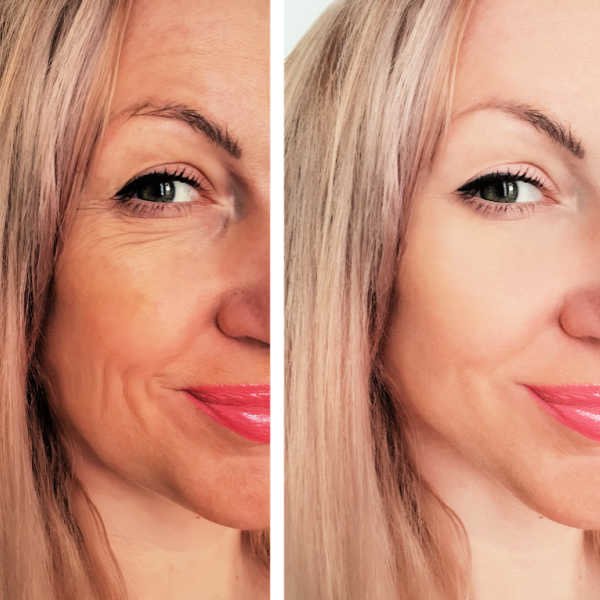 If you want to eliminate the wrinkles of the face