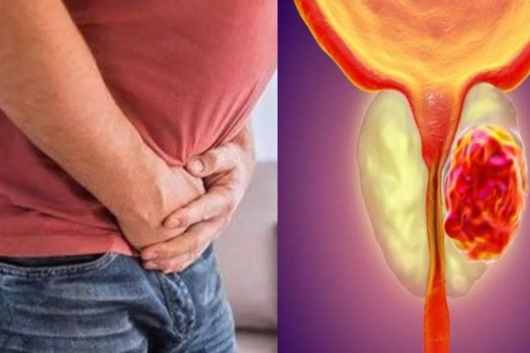 Prostate Cancer: 8 important questions related to prostate cancer in men